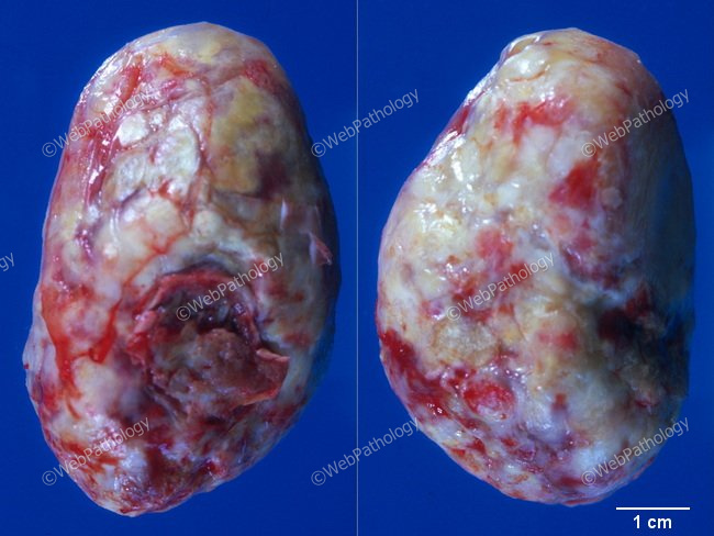 Heart_Tumors_Myxoma_Composite_resized (1).jpg